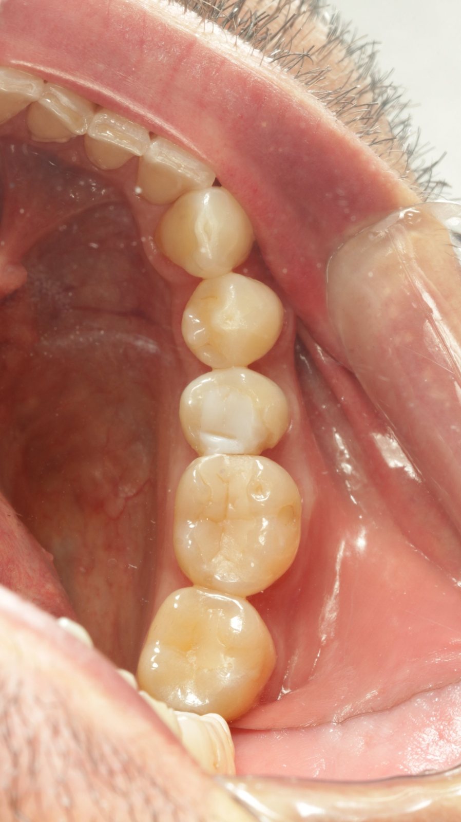 Antes: molares e pré-molares com restaurações antigas e anatomia oclusal achatada