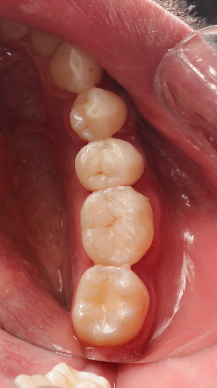 Depois: dentes posteriores restaurados com cúspides e sulcos definidos e polimento natural